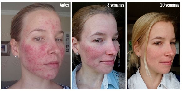 Orden roaccutane