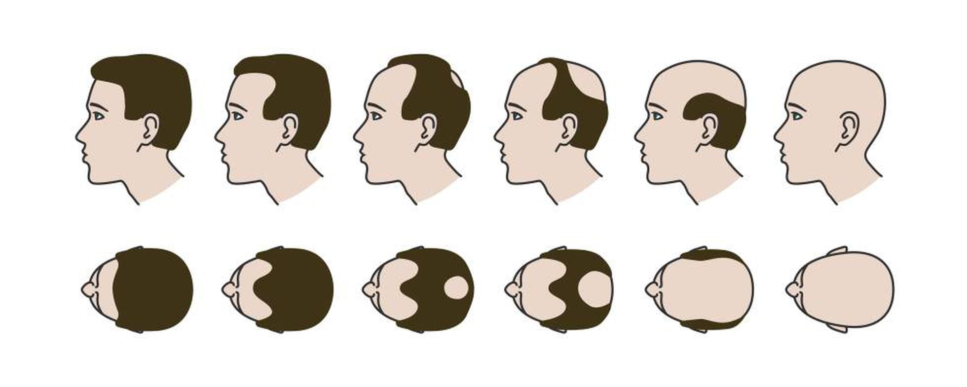 Finasteride 1 mg genérico