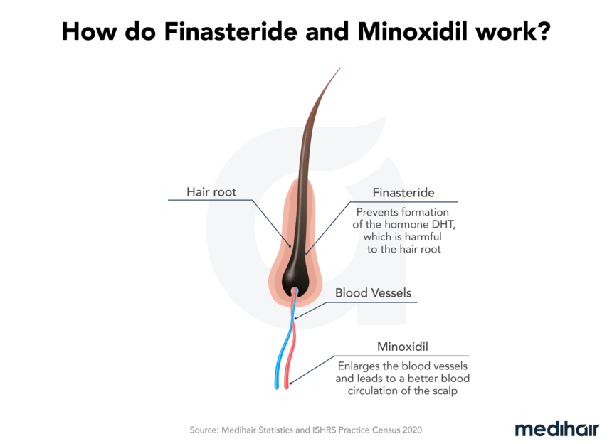 Finasteride 1 mg sin receta