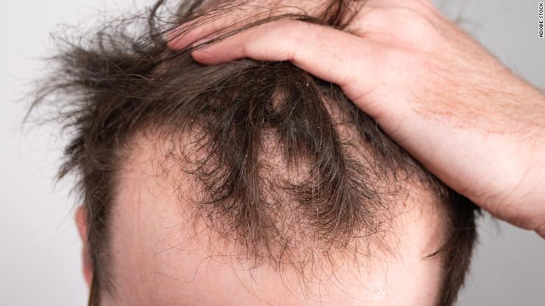 Finasteride lo venden sin receta