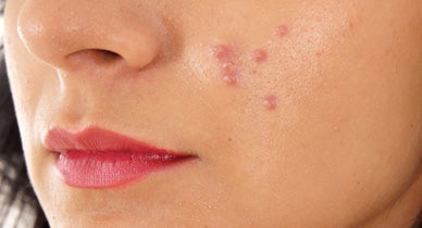 Roaccutane 40mg online