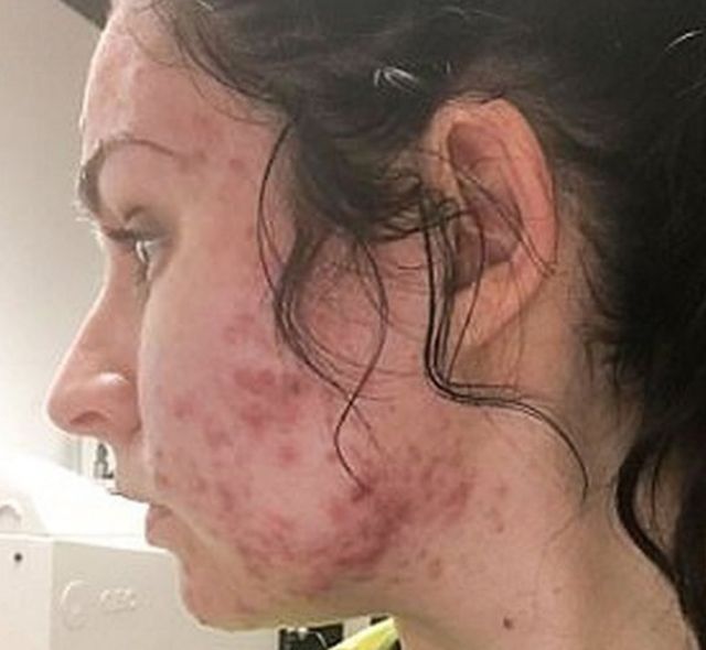 accutane precio mexico