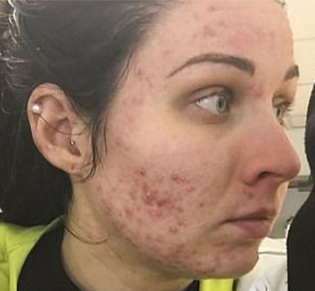 roaccutane en el mostrador