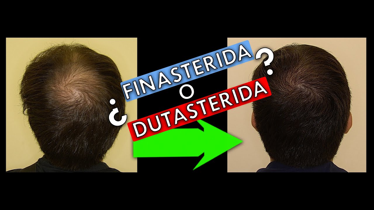 Finasteride barato