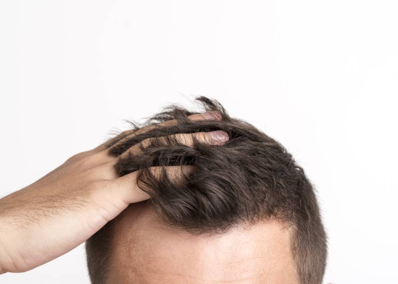 Finasteride sin receta medica