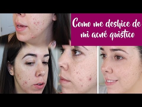 Roaccutane Cómo Comprar