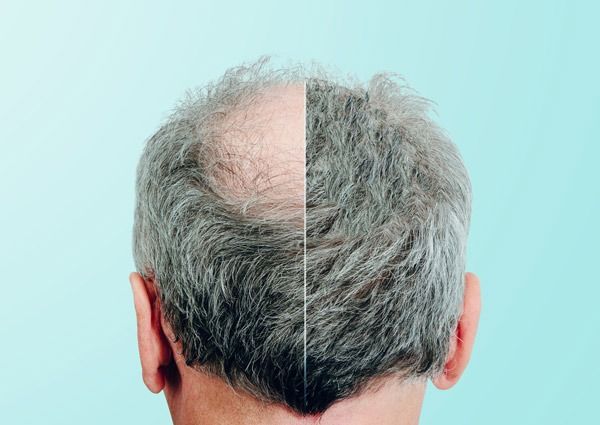 Donde comprar finasteride sin receta