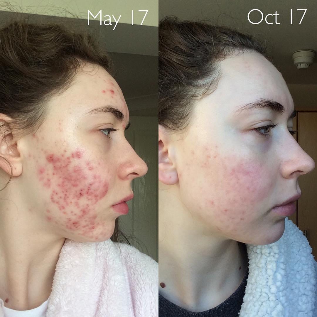 Accutane on-line