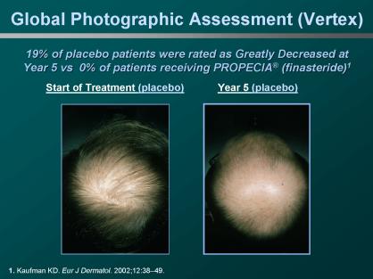 ordenar finasteride en línea