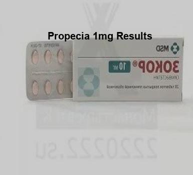 propecia 1 mg comprar