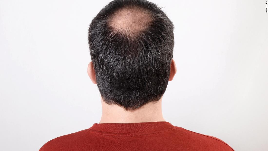 Finasteride se vende sin receta