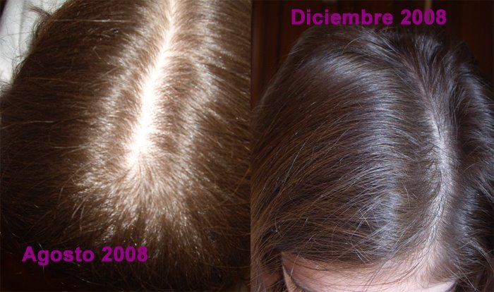 finasteride pastillas mujer