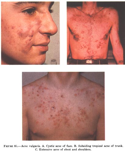 Isotretinoina acne precio