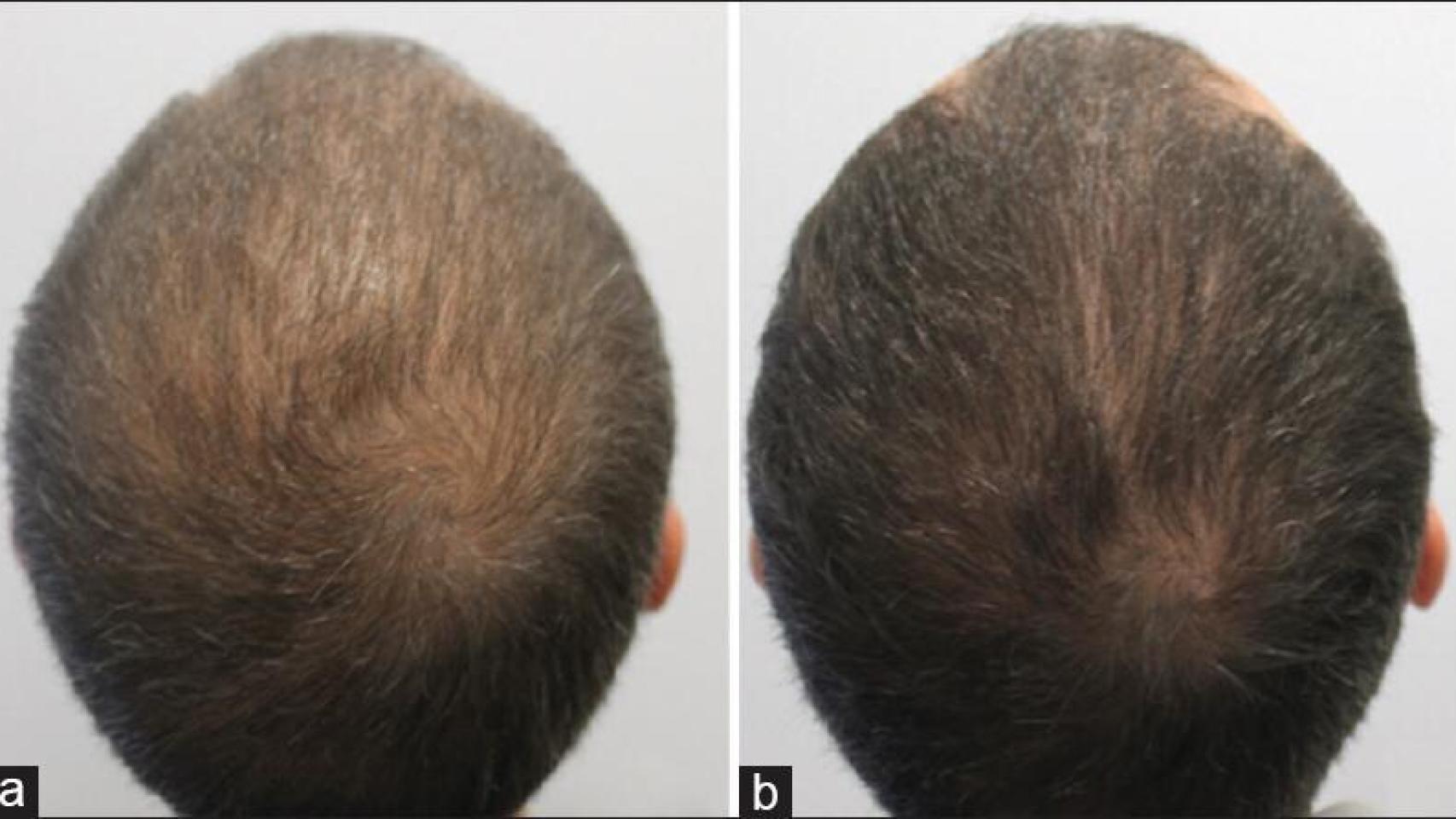 Finasteride farmacia españa