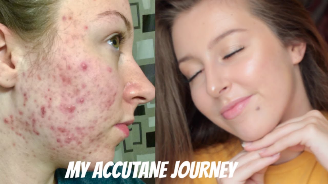 Precio de accutane