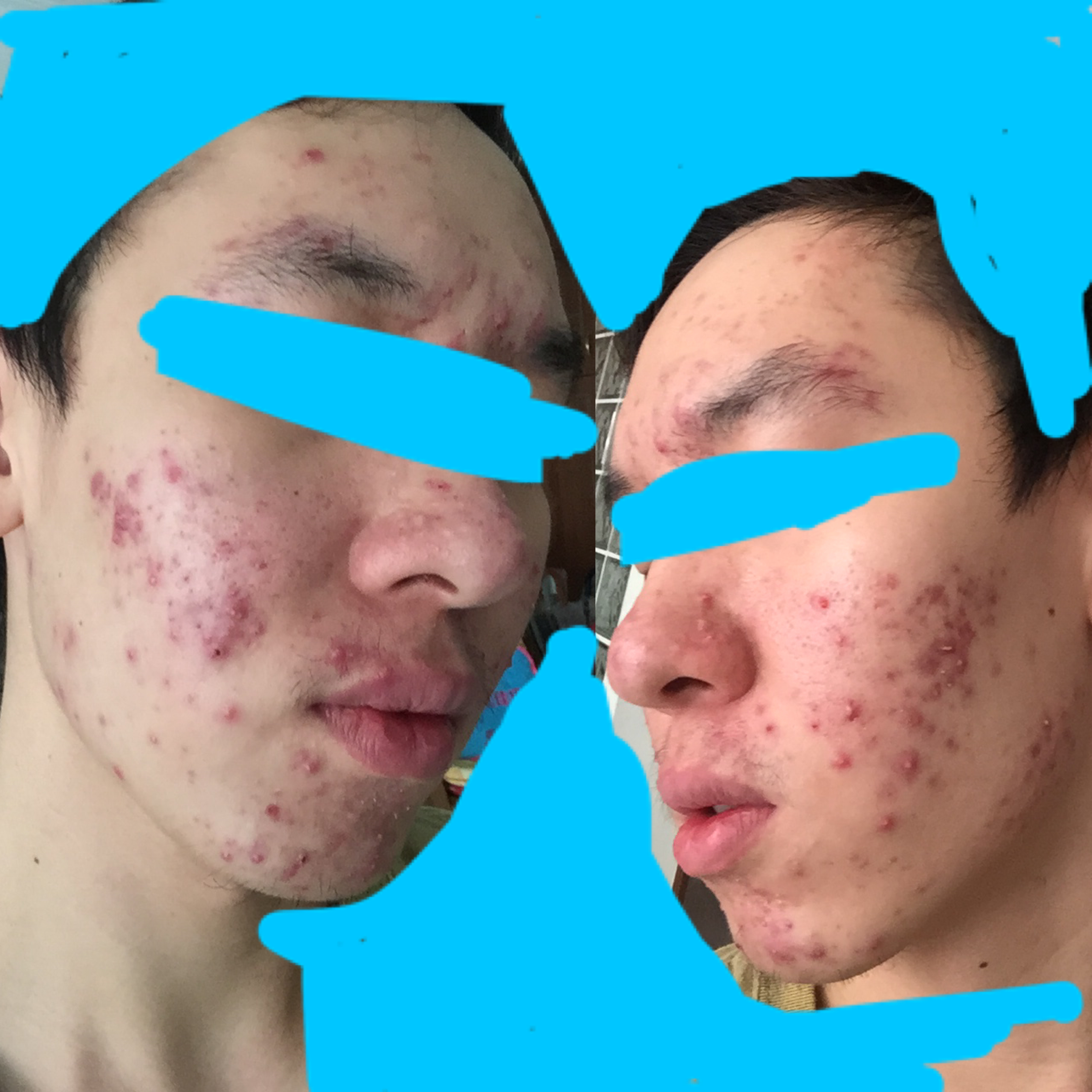 Accutane 10mg online