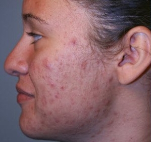 Accutane Como Comprar