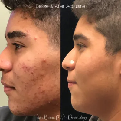 Accutane on-line