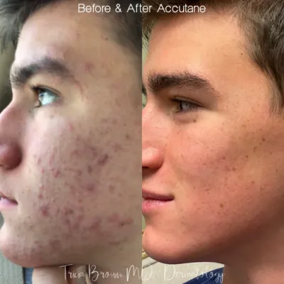 Accutane on-line