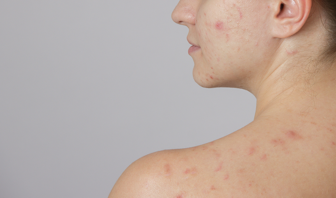 Roaccutane como comprar