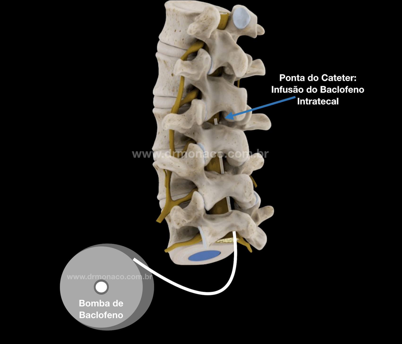 Baclofen comprar online