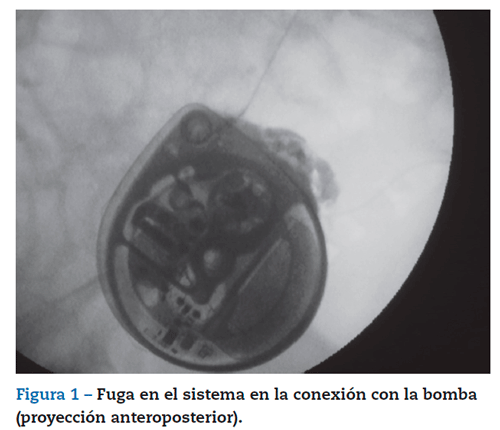 Baclofen En España