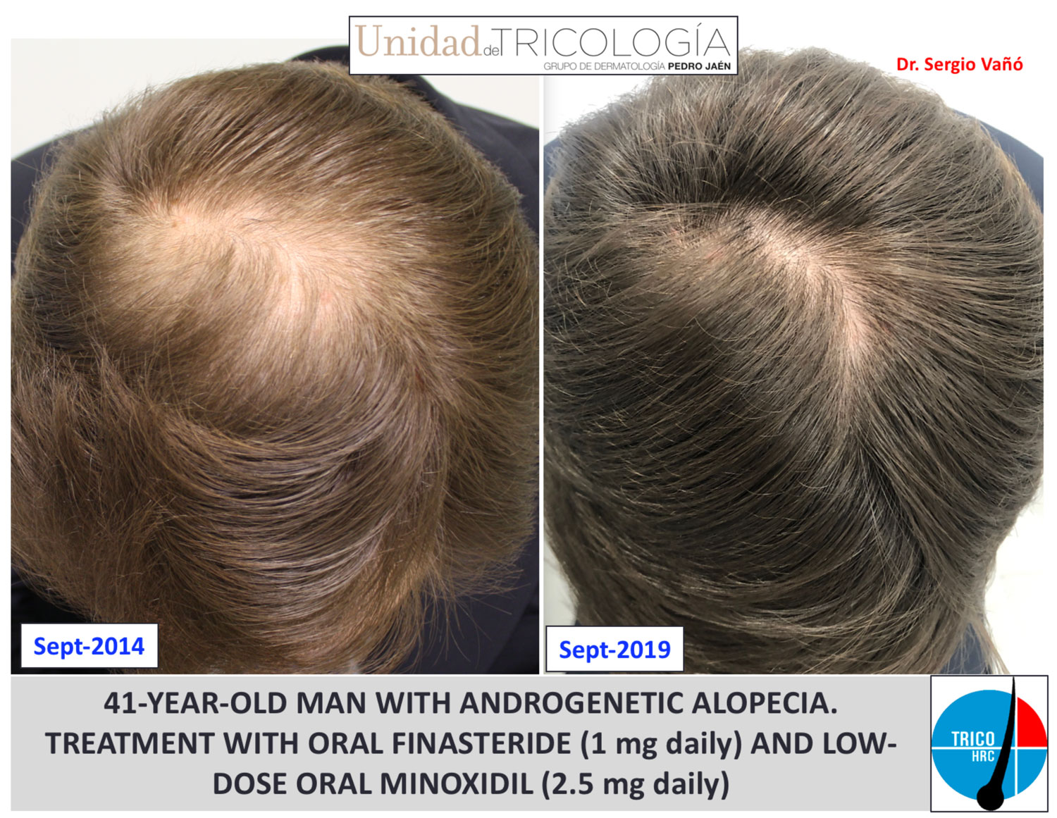 Comprar finasteride 1 mg españa