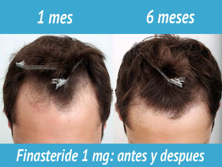 Finasteride Maxpil Precio