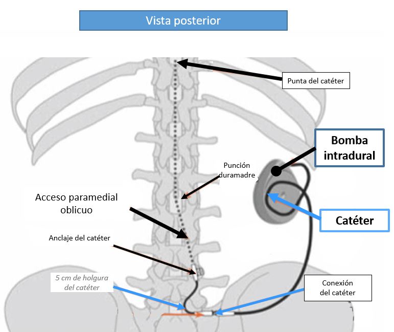 baclofeno intratecal precio