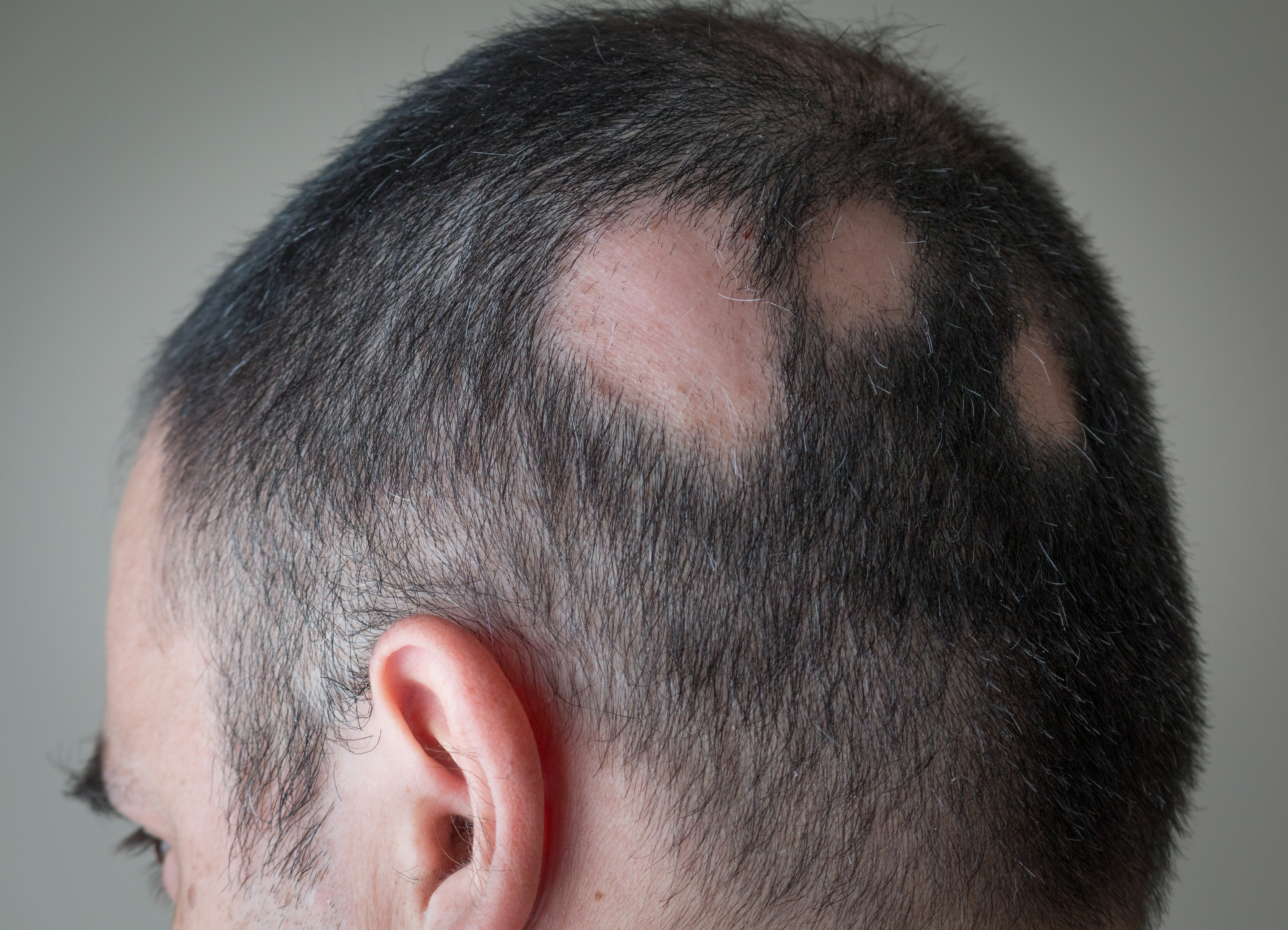 Cuanto cuesta finasteride en españa