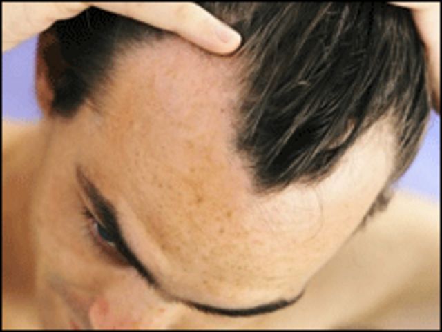 donde consigo finasteride en mexico