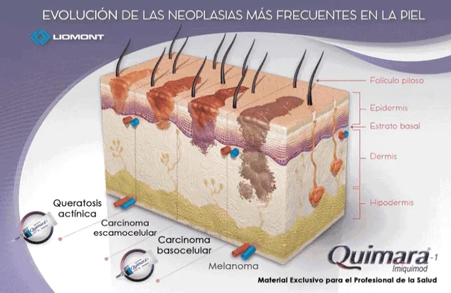 Imiquimod costo mexico