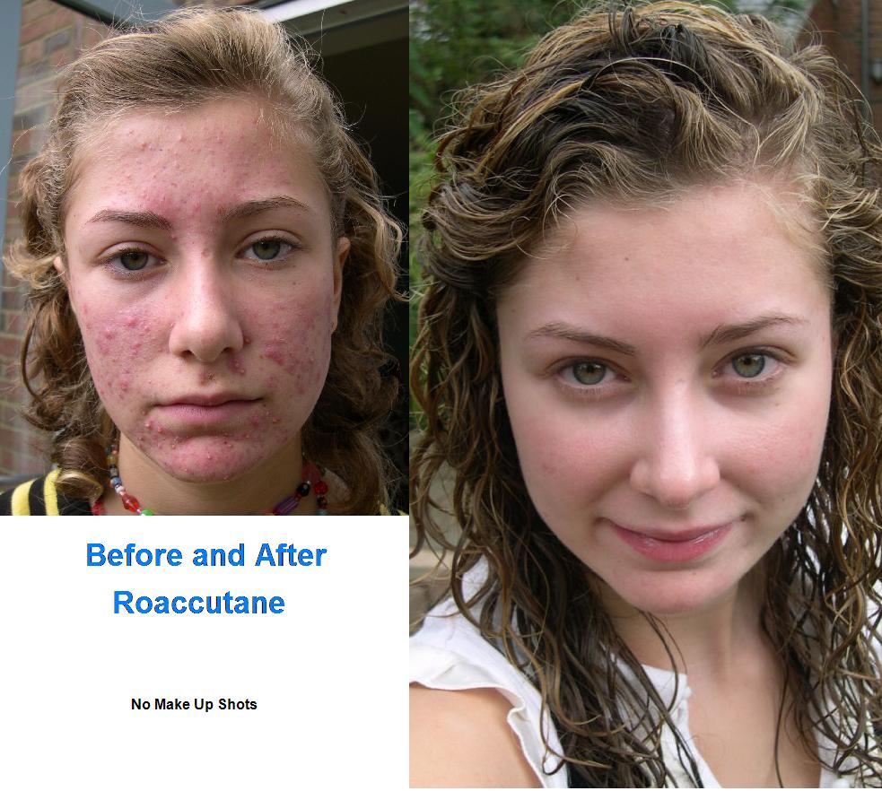 Roaccutane comprar