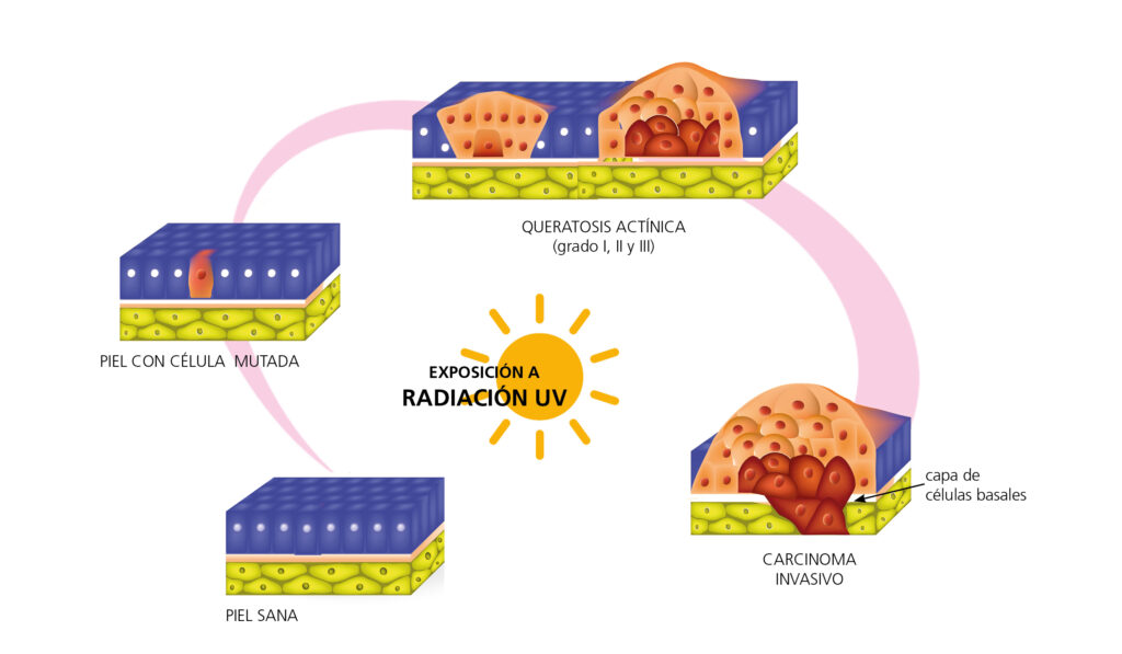 Imiquimod comprar españa