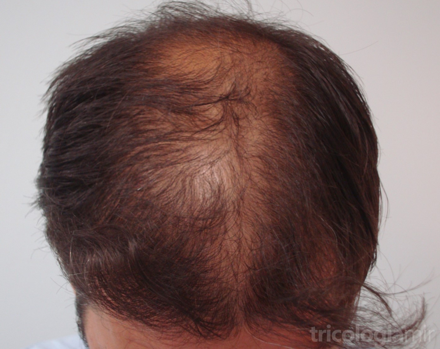 Finasteride 1mg comprar online