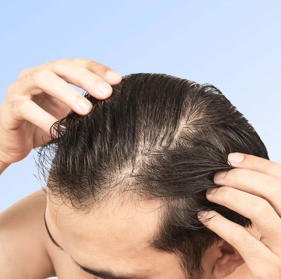 Finasteride Capelli Costo