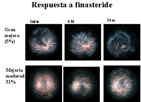 Finasteride cinfa precio