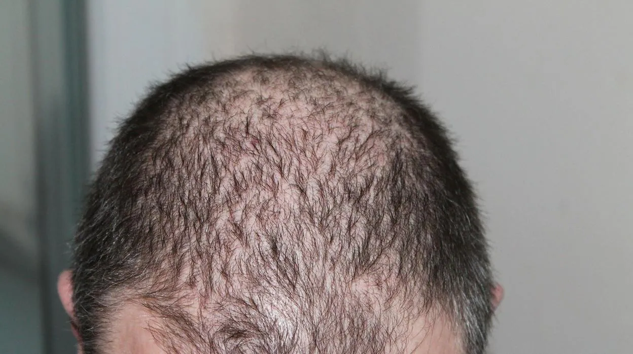 Finasteride Precio En Estados Unidos