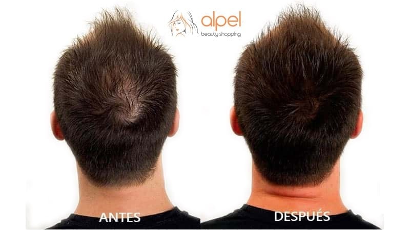 Finasteride precios de remedios