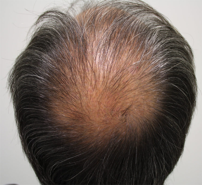 Orden de finasteride