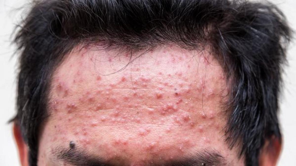 Roaccutane comprar españa