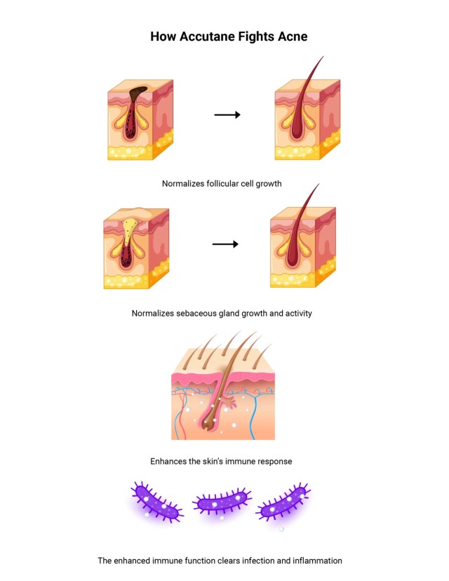 Roaccutane on-line