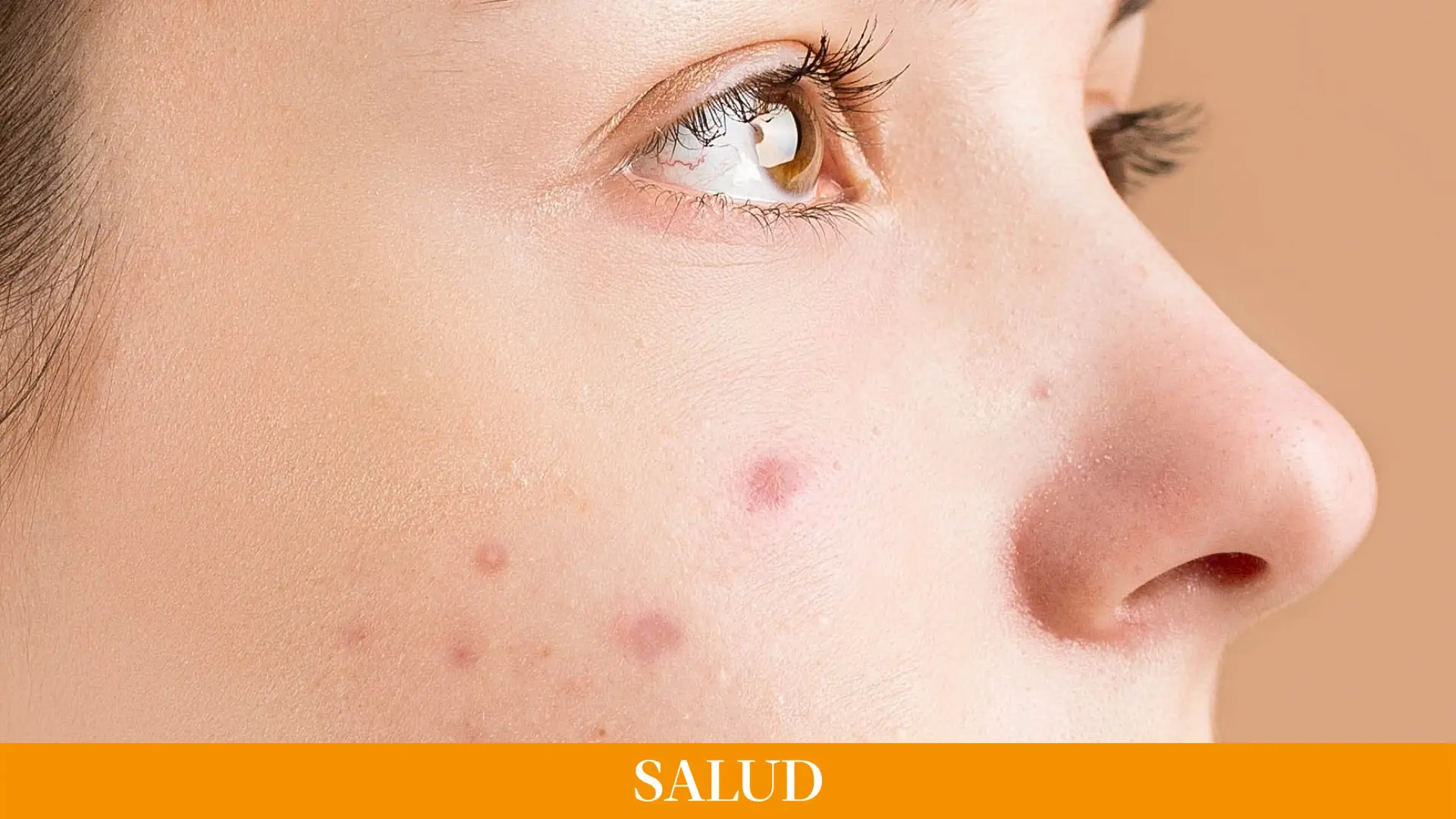 roaccutane sin receta