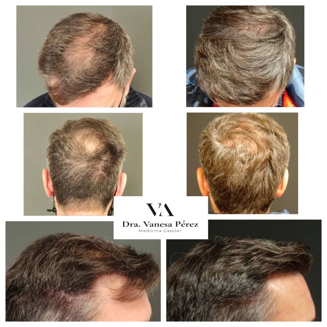 Venta de finasteride online